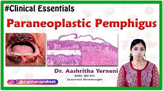 Paraneoplastic pemphigus Clinical essentials Dr Aashritha yerneni [upl. by Nois664]