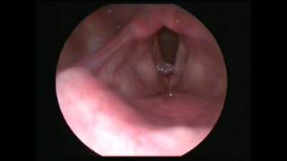 Vocal cord polyp Satyam Ent Care Centre Gwalior Dr Ravindra Bansal [upl. by Hillell]