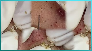 Big Cystic Acne Blackheads Extraction Blackheads amp Milia Whiteheads Removal Pimple Popping [upl. by Kcirad]