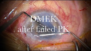 DMEK after failed PK in a vitrectomized eye [upl. by Sue]