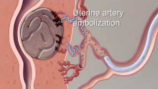 Fibroid Treatment Options  Mayo Clinic [upl. by Leverett]