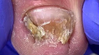 Small deep toenails Years of toenail fungus plagued ladies【Liu Yidao】 [upl. by Nerrej187]