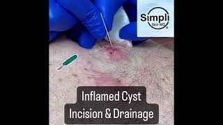 Inflamed Cyst Incision amp Drainage [upl. by Beach]