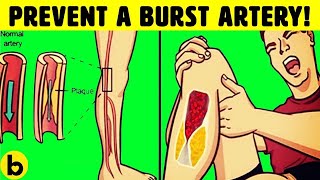 How To Prevent Blood Clots And Stop A Bursting Artery [upl. by Etolas577]