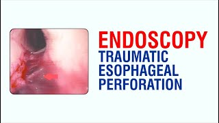 Endoscopy Traumatic Esophageal Perforation  Best Gastroenterologist Doctor in Patna [upl. by Ennazus]