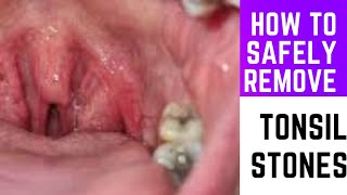 What are tonsil stones and how to remove them safely [upl. by Esmerolda]