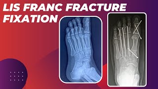 LISFRANC FRACTURE FIXATION IN A YOUNG MALE ASSOCIATED WITH MULTIPLE METATARSAL FRACTURES [upl. by Corrie627]