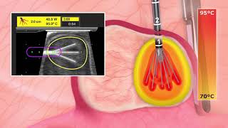 Acessa Procedure Quick Overview Animation [upl. by Nipahc]