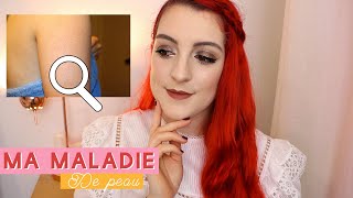 Ma maladie de peau  je vous dis tout 😫 Kératose Pilaire amp mes conseils   LOdoesmakeup [upl. by Channing897]