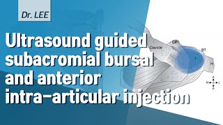 TrailerUSguided shoulder subacromial bursal and anterior approach of intraarticular injection [upl. by Margarida673]