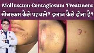 Molluscum Contagiosum Treatment In Hindi  Molluscum Contagiosum का इलाज  Molluscum कैसे पहचाने [upl. by Sabec]