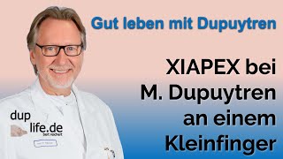 Anwendung von XIAPEX bei Dupuytren Kontraktur am Kleinfinger [upl. by Nnyled]