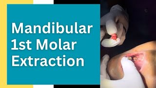 Mandibular First Molar Extraction dentistry dentistry youtube dentalimplants [upl. by Hsihsa]