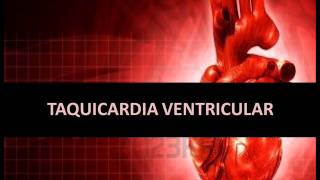 Arritmias cardíacas  Taquicardia ventricular [upl. by Bashee]