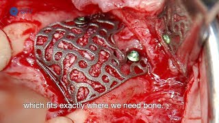 Customized Bone Regeneration CBR with Titanium Mesh LiveOP 2017 [upl. by Whitehurst318]