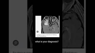 meningiomawhat u should check [upl. by Eugatnom]