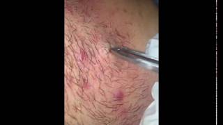 GROSS amp GRAPHIC HUGE INGROWN HAIRS INSIDE NECK [upl. by Cecilia578]