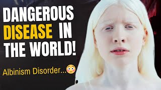 The Albinism Disorder  Dangerous or Normal   HindiUrdu  AR Research [upl. by Aonian]