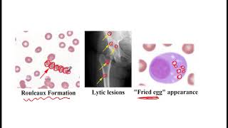 USMLE ACE Video 60 Multiple myeloma Waldenström macroglobulinemia and MGUS [upl. by Macur]