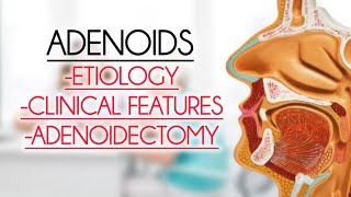 ADENOIDS ETIOLOGY CLINICAL FEATURESADENOIDECTOMY [upl. by Andromada]