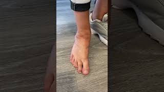 Video  over pronation is still a thing [upl. by Victor509]