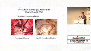 Mitral Valve Pathoanatomy Strategic Assessment [upl. by Winer]