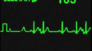 Atrial Trigeminy  ECG Simulator  Arrhythmia Simulator [upl. by Glory]