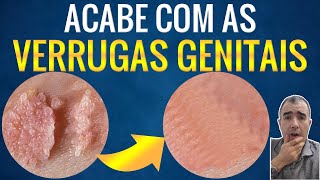 Como remover e destruir VERRUGA NA GENITAL por HPV [upl. by Eilsek]