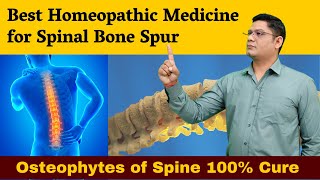 Best Homeopathic Medicine for Spinal Bone Spur Osteophytes of Spine 100 cure  Dr Sunil Patidar [upl. by Savory257]