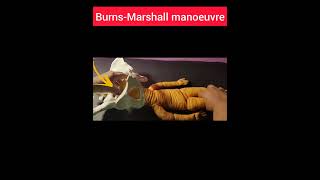 Burns  Marshall Techniquenormaldelivery normallabour breechdelivery [upl. by Aneeuqahs]