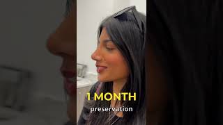 Preservation Rhinoplasty 1 Month PostOp [upl. by Geer]