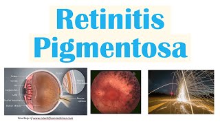 Retinitis Pigmentosa  Genetics Pathophysiology Signs amp Symptoms Diagnosis Treatment [upl. by Enaxor578]