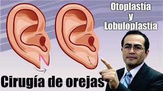 Otoplastia y lobuloplastía 👂🏼 Tipos de CIRUGÍA de OREJAS ❤️ Dr PERCY NEVADO Cirugía Plástica [upl. by Stevana]