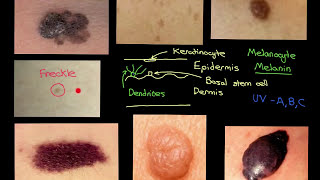 Melanocytic Lesions Part 2 [upl. by Idolah]