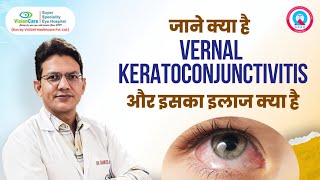 क्या है Vernal Keratoconjunctivitis और इसका इलाज क्या है  VisionCare Super Specialty Eye Hospital [upl. by Hirza]