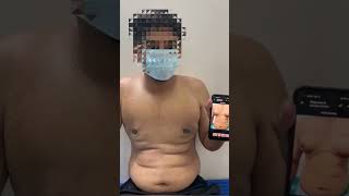 Gynecomastia Grade 2 Patient Feedback After 3 Days  Dr Deepesh Goyal  Rejuvena Cosmo Care Jaipur [upl. by Ariaek]