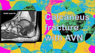 Neglected calcaneal fracture with calcaneal osteonecrosis  ankle 54 ENG [upl. by Thistle488]