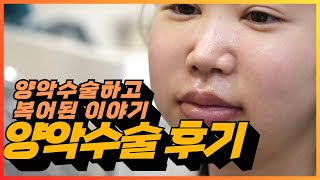 양악수술 후기 브이로그 양악수술 후 1주 후 2주 후 [upl. by Brawner]