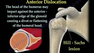 Shoulder Dislocations  Everything You Need To Know [upl. by Irem]