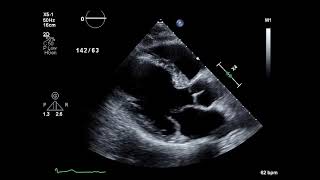 Posterior Mitral Valve Prolapse [upl. by Malchus563]