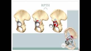 Intérêt du cotyle double mobilité dans les reconstructions prothétiques de la hanche [upl. by Yelkcub]