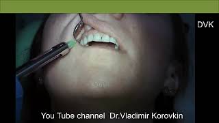 Infiltration anesthesia for treatment 13 tooth [upl. by Atalanti]