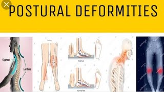 Postural deformity Health education [upl. by Secor]