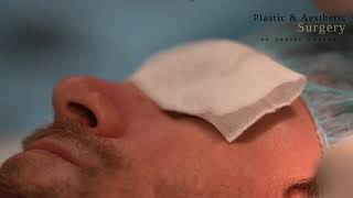 Intradermal nevus removal [upl. by Amimej]