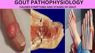 PATHOPHYSIOLOGY OF GOUTHYPERURECEMIAMONOSODIUM URATE CRYSTALSSTAGES OF GOUTSYMPTOMS OF GOUT [upl. by Frear]