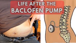 From uncontrollable spasms to relaxed limbs  Life before and after a Baclofen Pump [upl. by Henricks]