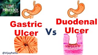 Peptic Ulcer Disease GASTRIC VS DUODENAL ULCERS [upl. by Nwahsit]