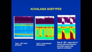 Achalasia is the esophageal motility abnormality [upl. by Galang641]