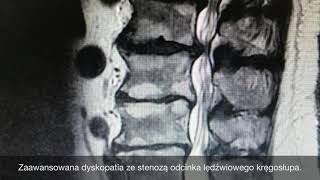 Dyskopatia i przepuklina krążka jak wyglądają na rezonansie magnetycznym [upl. by Nigle]