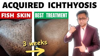 Acquired ichthyosis  Fish skin  Treatment  Hindi [upl. by Sirron]